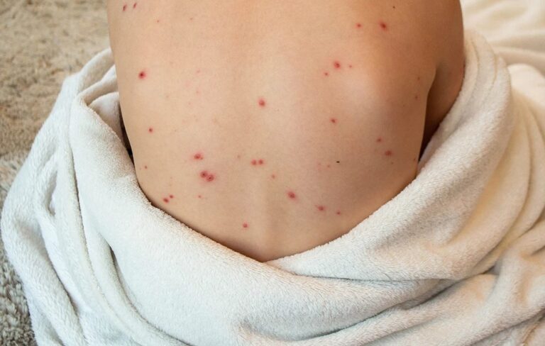 Κρήτη | «Καμπανάκι» κινδύνου για την ιλαρά – Χωρίς ανησυχητικά κρούσματα στα νοσοκομεία του νησιού